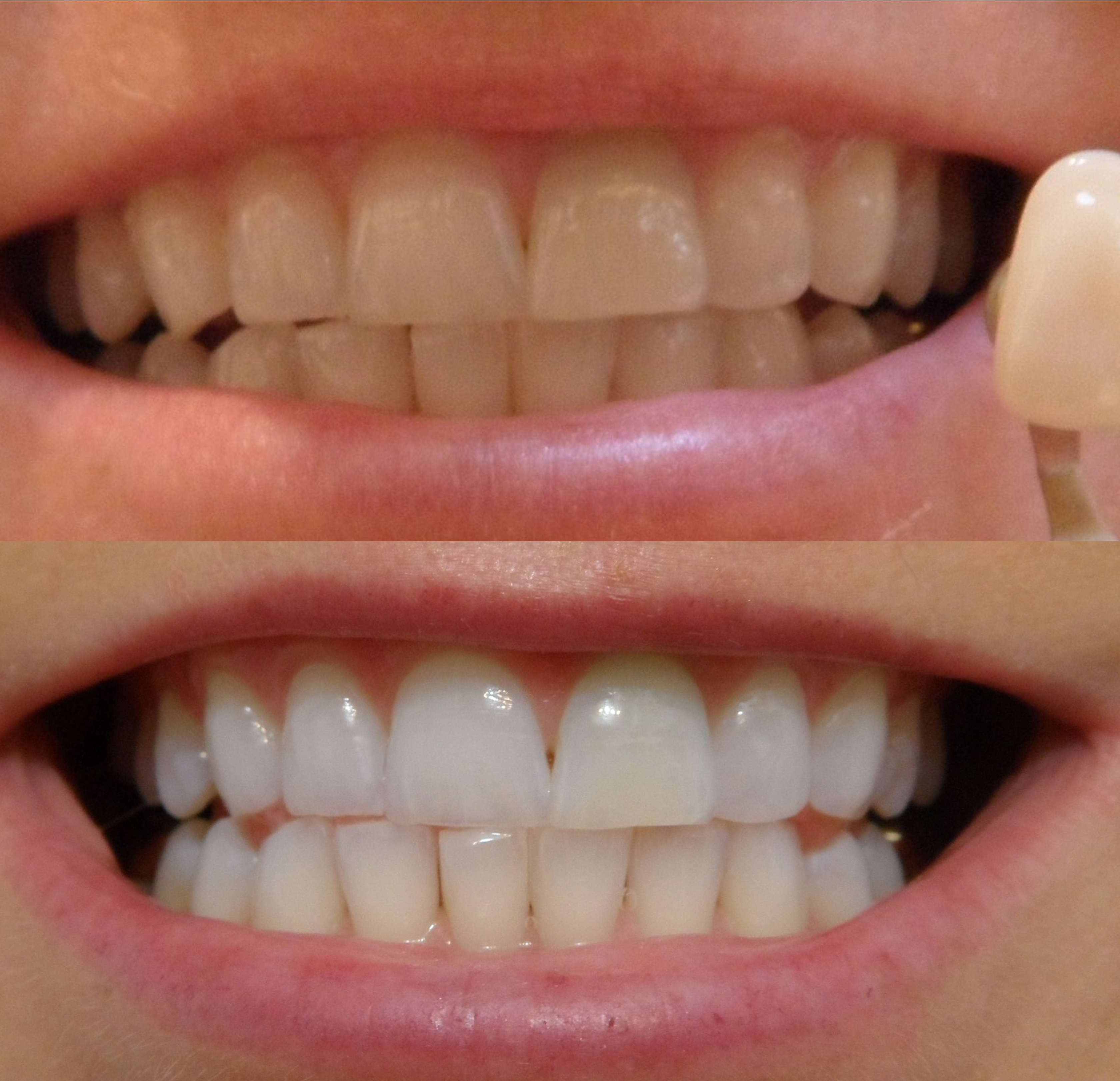 Bleachbright Starbright Teeth Whitening Dual Action Gel ...